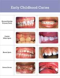 Stages of early childhood tooth decay visual comparison.