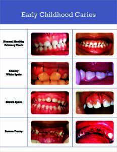 Stages of early childhood tooth decay visual guide.